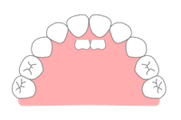 永久歯が乳歯の裏側に生えてきた